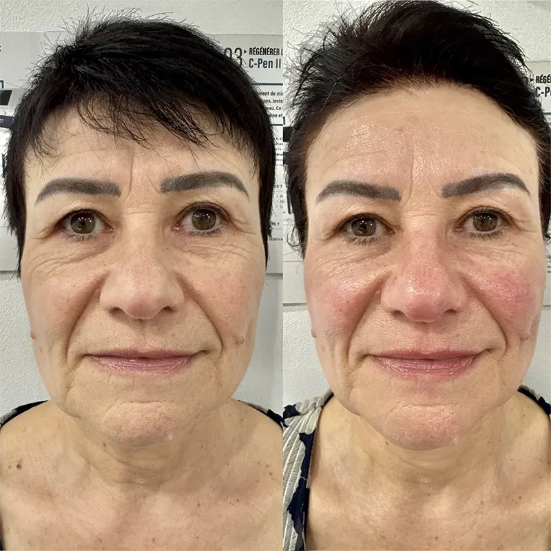 photo ref hifu